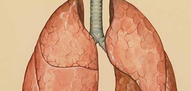 أعراض مرض ذات الجنب أعراض مرض ذات الجنب