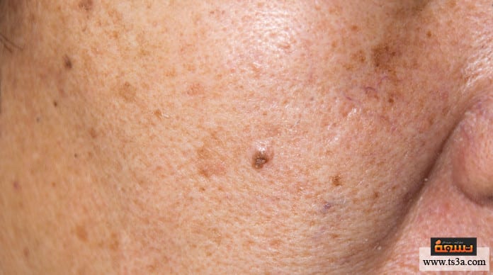 d8a5d8b2d8a7d984d8a9-d8a7d984d986d985d8b4-d988d8b5d981d8a7d8aa-d8a5d8b2d8a7d984d8a9-d8a7d984d986d985d8b4-d8a8d8a3d8b3d8b1d8b9-d988d982d8aa إزالة النمش وصفات إزالة النمش بأسرع وقت