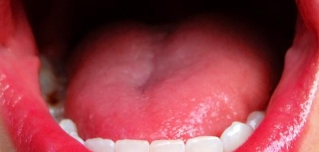 احمرار اللسان احمرار اللسان