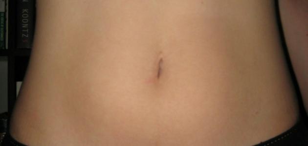 التهاب السرة التهاب السرة