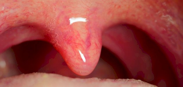 اللهاة: موقعها، وظائفها، أمراضها، هل يمكن البقاء بدونها؟ اللهاة: موقعها، وظائفها، أمراضها، هل يمكن البقاء بدونها؟