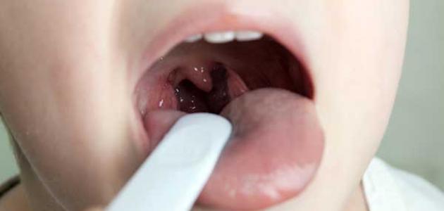 تشخيص التهاب الحلق المزمن تشخيص التهاب الحلق المزمن