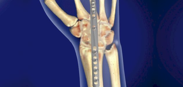 جراحة تثبيت المفصل: أسباب إجرائها والنتائج المنتظرة منها جراحة تثبيت المفصل: أسباب إجرائها والنتائج المنتظرة منها