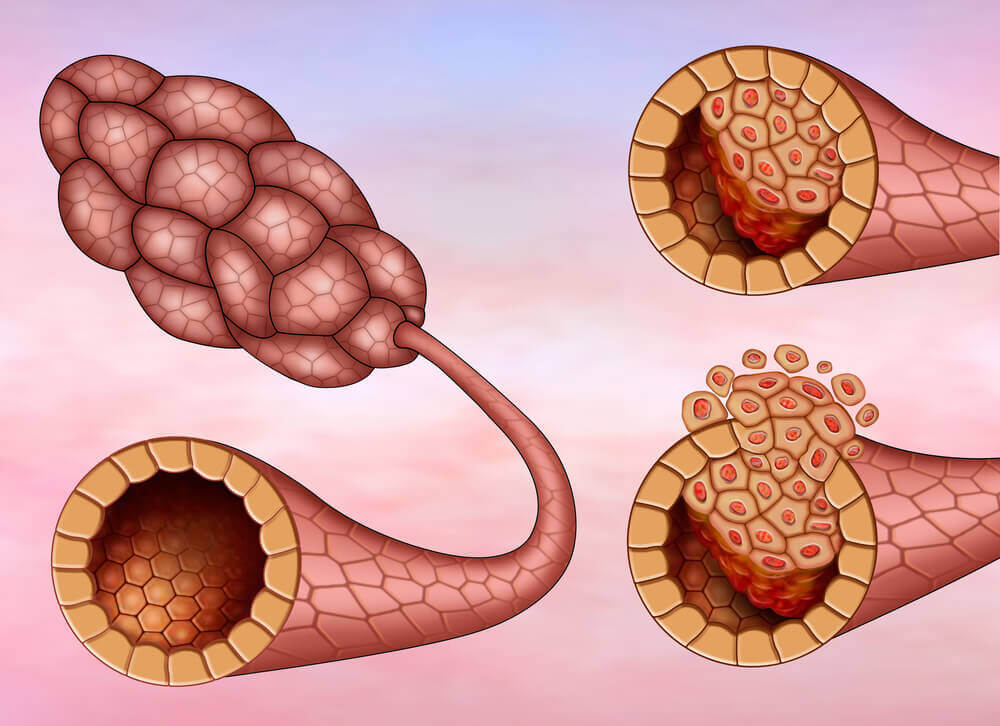 سرطان الثدي و العقدة الخافرة