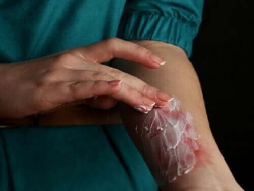 d8b9d984d8a7d8ac-d8a7d984d8add8b1d988d982-d8a7d984d8b3d8b7d8add98ad8a9 علاج الحروق السطحية