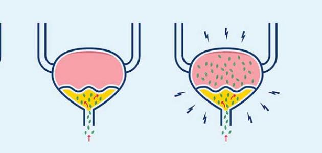 علاج التهاب المسالك البولية بالأعشاب: حقيقة أم خرافة قد تضرك؟