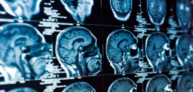 علاج قصور الدورة الدموية المخية بالأعشاب: حقيقة أم خرافة قد تضرك؟ علاج قصور الدورة الدموية المخية بالأعشاب: حقيقة أم خرافة قد تضرك؟