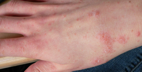 e63772f2034b8fe88da44ad5e750e3d3-1 الجرب في تركيا، لماذا انتشر؟