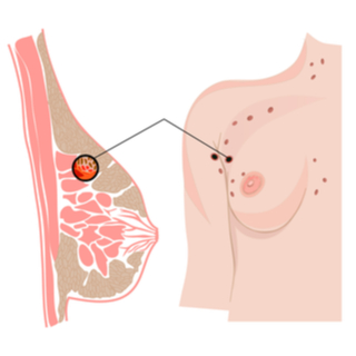 ما هو سرطان الثدي؟ ما هو سرطان الثدي؟