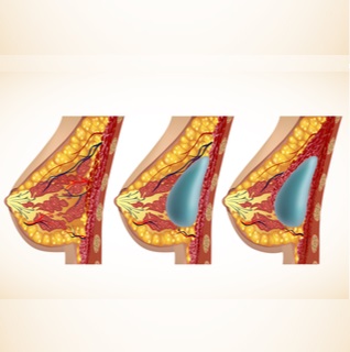 التورم في الثدي ومحيطه التورم في الثدي ومحيطه