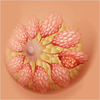 انكماش الحلمة أو انقلابها انكماش الحلمة أو انقلابها