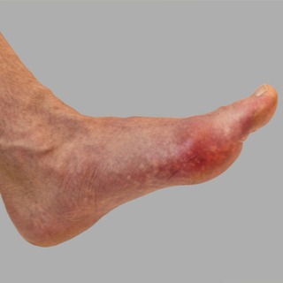 الاحمرار والتورم المؤلم الاحمرار والتورم المؤلم