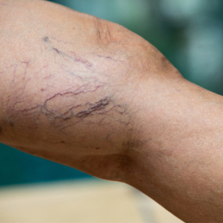 ما هو مرض الدوالي العنكبوتية؟ ما هو مرض الدوالي العنكبوتية؟