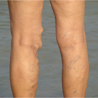 أنواع الدوالي أنواع الدوالي