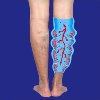 أسباب مرض الدوالي العنكبوتية أسباب مرض الدوالي العنكبوتية