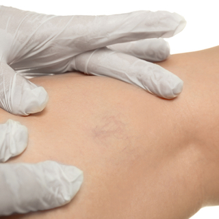 تشخيص مرض الدوالي العنكبوتية تشخيص مرض الدوالي العنكبوتية