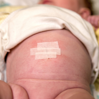 علاج أعراض الفتق السري عند الرضع علاج أعراض الفتق السري عند الرضع