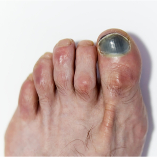 أظافر زرقاء أظافر زرقاء