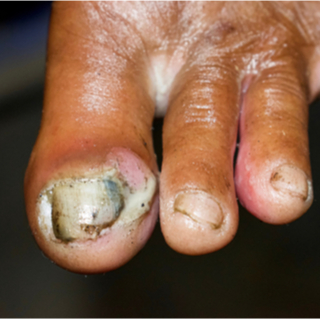 أظافر سوداء مخضرة أظافر سوداء مخضرة