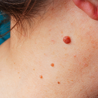 مكان ظهور سرطان الجلد الحميد