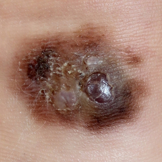 أعراض سرطان الجلد الحميد