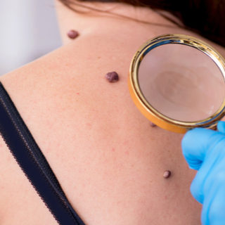 متى تكون الشامة سرطانية؟