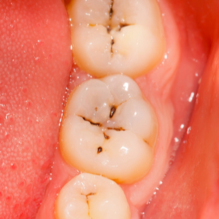 تسوس الحفر والشقوق تسوس الحفر والشقوق