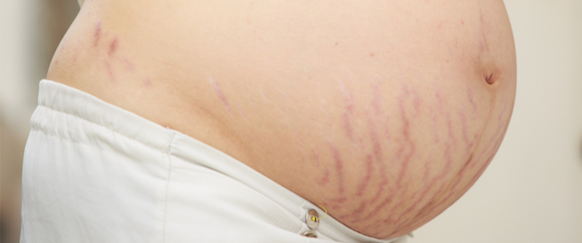 tbl_articles_article_24415_213f829cc5f-fb46-4dd2-b6b3-193e10a53ebc متى تبدأ تشققات البطن عند الحامل؟