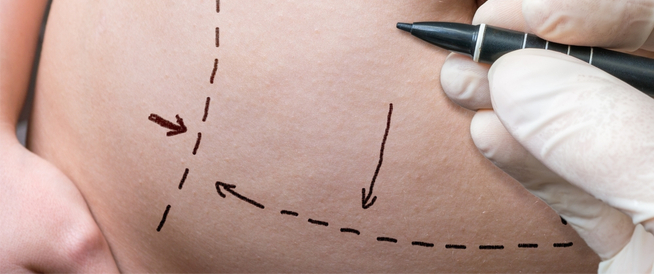 tbl_articles_article_24495_972c302c963-aec4-46db-a9e1-1d7cc89a5821 عملية شد البطن: دليلك الشامل