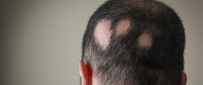 tbl_articles_article_24593_3562fd219d6-2f62-46a7-94e5-51a4a0db25f1 تعرف على أنواع الثعلبة