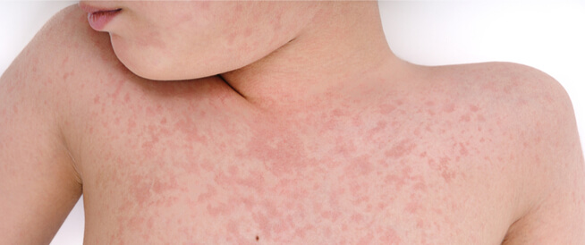 tbl_articles_article_24601_74676e1a33b-2263-4ac5-8869-8c1cfff1ce70 تعرف على أنواع الطفح الجلدي