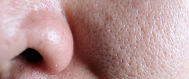 tbl_articles_article_24902_251941f1474-bba3-4551-8ec9-c5df2ad5a60b هل يمكن علاج المسامات الواسعة طبيًا؟