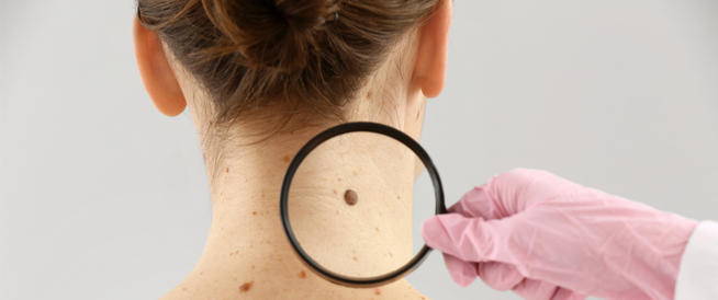 tbl_articles_article_24940_8711f4366c8-1a7d-43a1-8ce8-bbe98f546c14 إزالة الشامة البارزة طبيعيًّا: هل هو ممكن؟