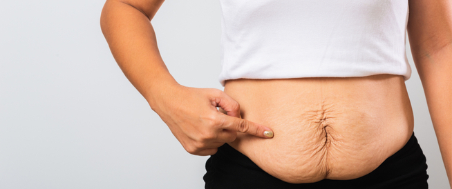 tbl_articles_article_25020_75838d69f08-cd77-4072-954d-3031b243b623 ترهلات البطن بعد الولادة: معلومات هامة