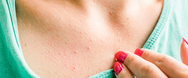 tbl_articles_article_25029_527fd847bfb-8276-4185-afa6-78d3944f01bc حبوب بين الثديين: كل ما يجب أن تعرفيه