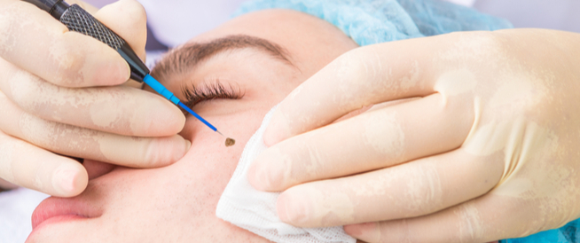 tbl_articles_article_25037_7271192efed-73eb-4c3c-b305-fbdfe14cd1f6 طرق إزالة الشامات من الوجه