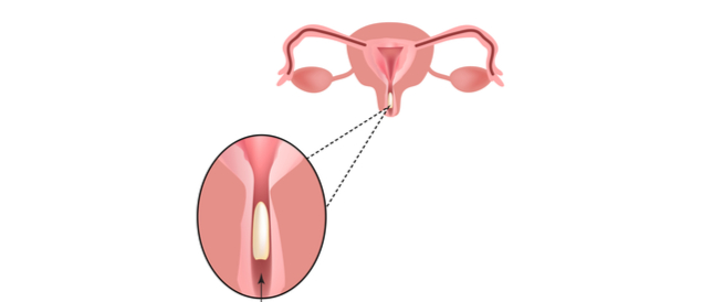tbl_articles_article_25125_9295b4ec0d9-6467-44b6-a167-4d911b429f18 ما هي تحاميل التثبيت؟ وما مخاطر استخدامها؟