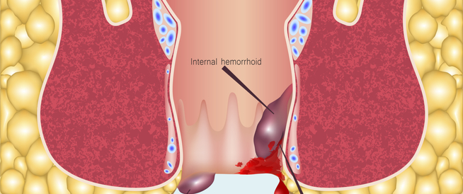 tbl_articles_article_25266_418f19d38a5-2827-4017-8508-c39cf66c2c49 تعرفي على أعراض البواسير بعد الولادة