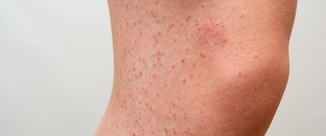 tbl_articles_article_25368_12fab4312-9cce-40ca-a510-9033f5e0168b كيفية التخلص من مسامات الساق