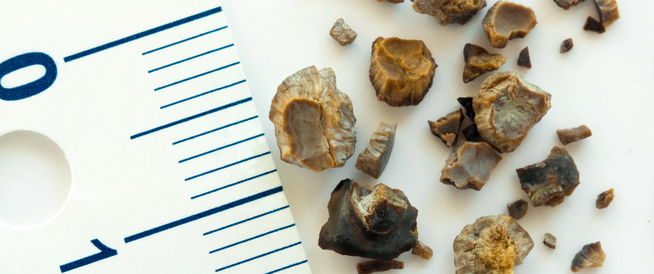 tbl_articles_article_25483_6240ed5bfbb-3a23-4de8-a7b8-0af45c51169e ما هو الفرق بين حصى المرارة وحصى الكلى