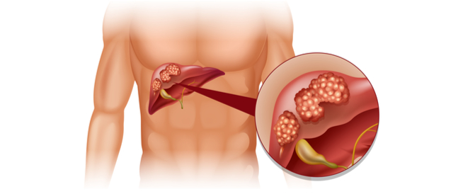 tbl_articles_article_25564_363cd726540-fe8f-44fa-bdb8-be0ed5559092 سرطان الكبد الثانوي