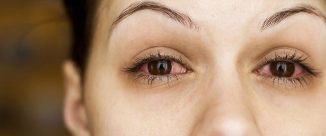 tbl_articles_article_25602_788b67d78db-5cb5-41e5-bc9a-3bf001c18f3d كم يدوم مرض الرمد وكيف يمكن علاحه؟