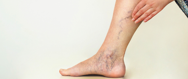 tbl_articles_article_25603_7289cc02a4d-cf06-4a00-8e21-33b60299e8c5 هل الدوالي مرض خطير؟