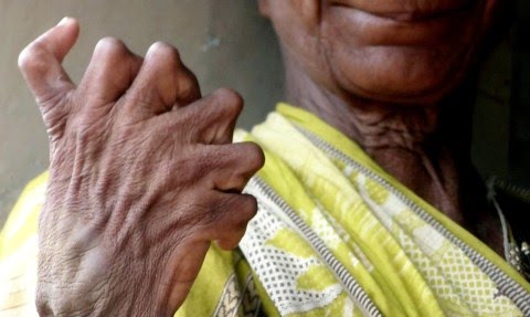 woman-born-with-20-toes-12-fingers-says-neighbors-call-her-a-witch-2