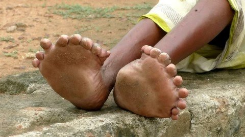 woman-born-with-20-toes-12-fingers-says-neighbors-call-her-a-witch