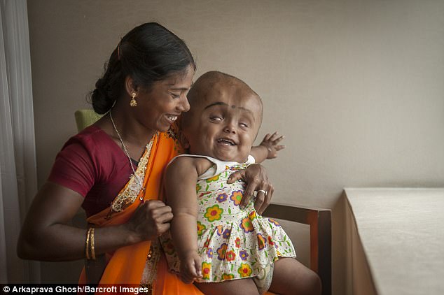 Mother Fatima had hoped Roona would one day lead a normal life and attend school, though surgeons warned this was unlikely