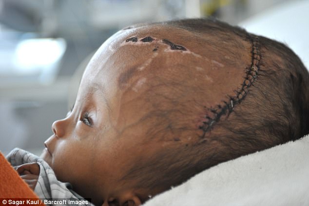 Roona underwent two rounds of surgery last year to relieve the swelling and reduce the size of her skull, and though doctors warned she could die she lived and showed improvement