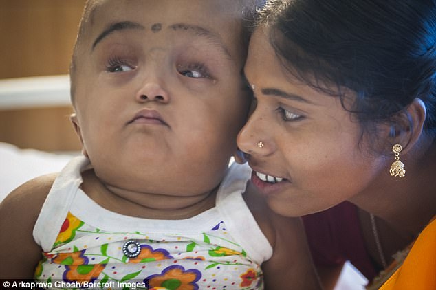 Roona learned to laugh, smile, turn her head on her own and react to her name being called following the first rounds of surgery