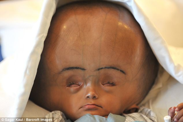Roona Begum, a five-year-old Indian girl suffering from hydrocephalus, or water on the brain, has died in her remote village home