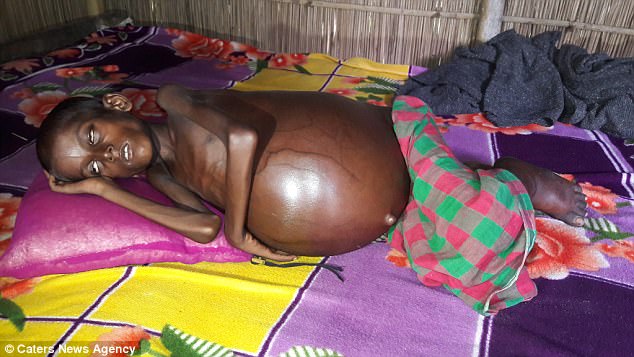 As a result of the heavy mass, he is unable to walk and throws up food every time he attempts to eat, local reports state